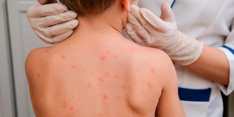 Желшешек ауа арқылы иммунитеті осал кез-келген балаға жұғуы мүмкін