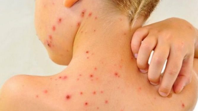 Түркістан облысында соңғы екі жылда қызылша ауруы тіркелмеді