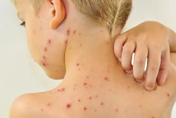 Қызылшаның қауіпі жоғары