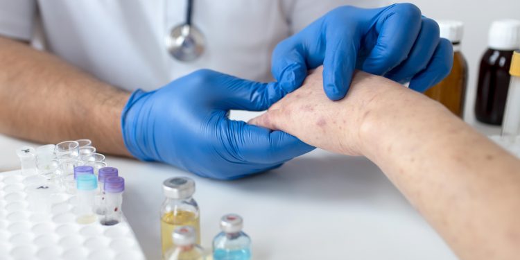 Эпидемиологическая ситуация по заболеваемости корью в Туркестанской области