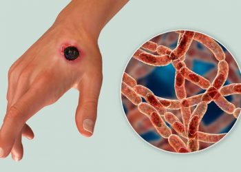 Сібір жарасы және оның алдын алу