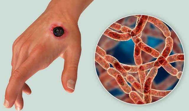 Сібір жарасы және оның алдын алу