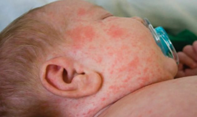 Қызылша ауруы дендеп тұр