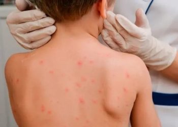 Қызылшаның алдын алу