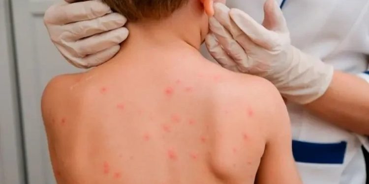 Қызылшаның алдын алу