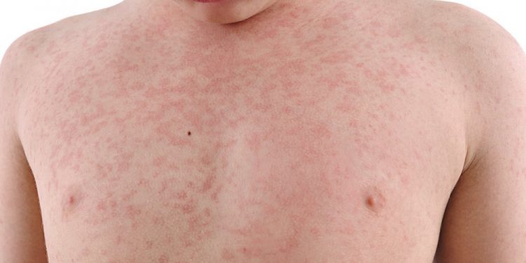 Қызылша ауруы туралы не білесіз?