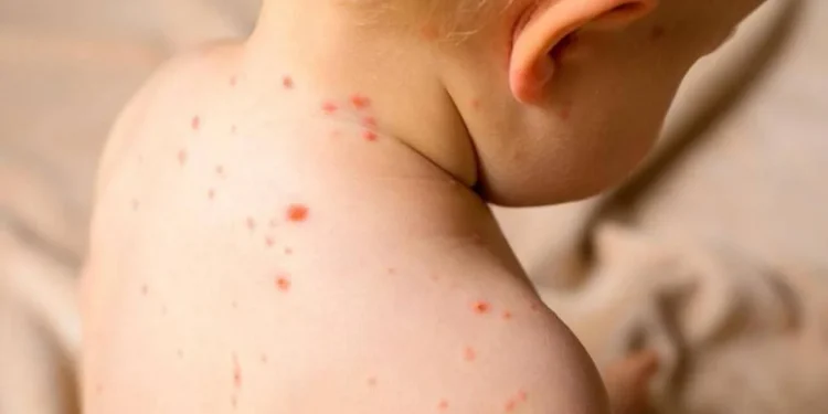 Қызылша инфекциясы