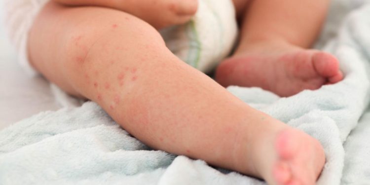 Қызылшадан қалай сақтану керек?