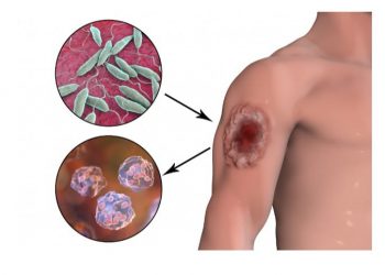 Тері лейшманиозы қауіпті ауру