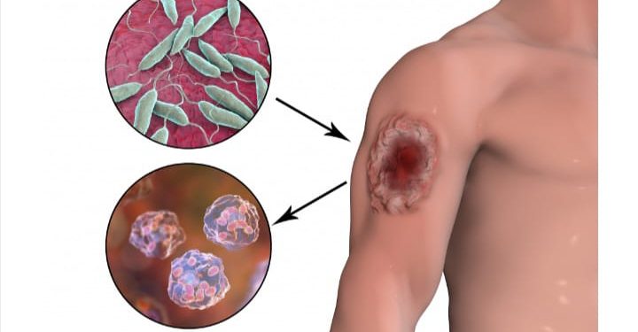 Тері лейшманиозы қауіпті ауру