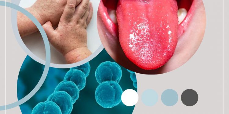 Скарлатина — инфекциялық жұқпалы ауру