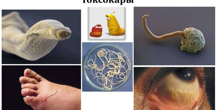 Токсокароздың адам денсаулығына қауіптілігі қандай?
