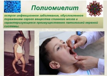 Полиомиелит – полиовирус әсерінен болатын жедел жұқпалы ауру