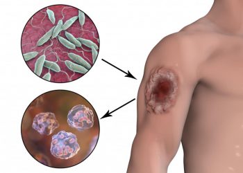 Тері лейшманиозы