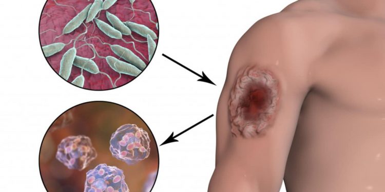 Тері лейшманиозы