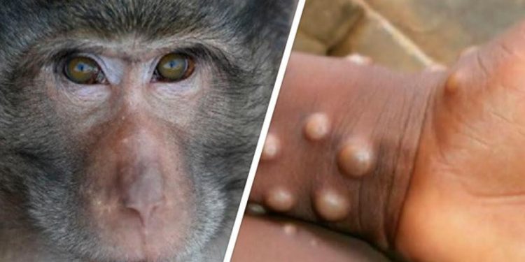 ЧТО НАМ НУЖНО ЗНАТЬ ОБ ОСПЕ ОБЕЗЬЯН?