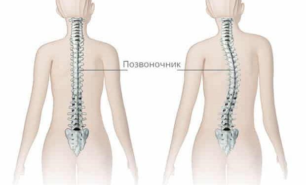Сколиозды қалай емдеуге болады?
